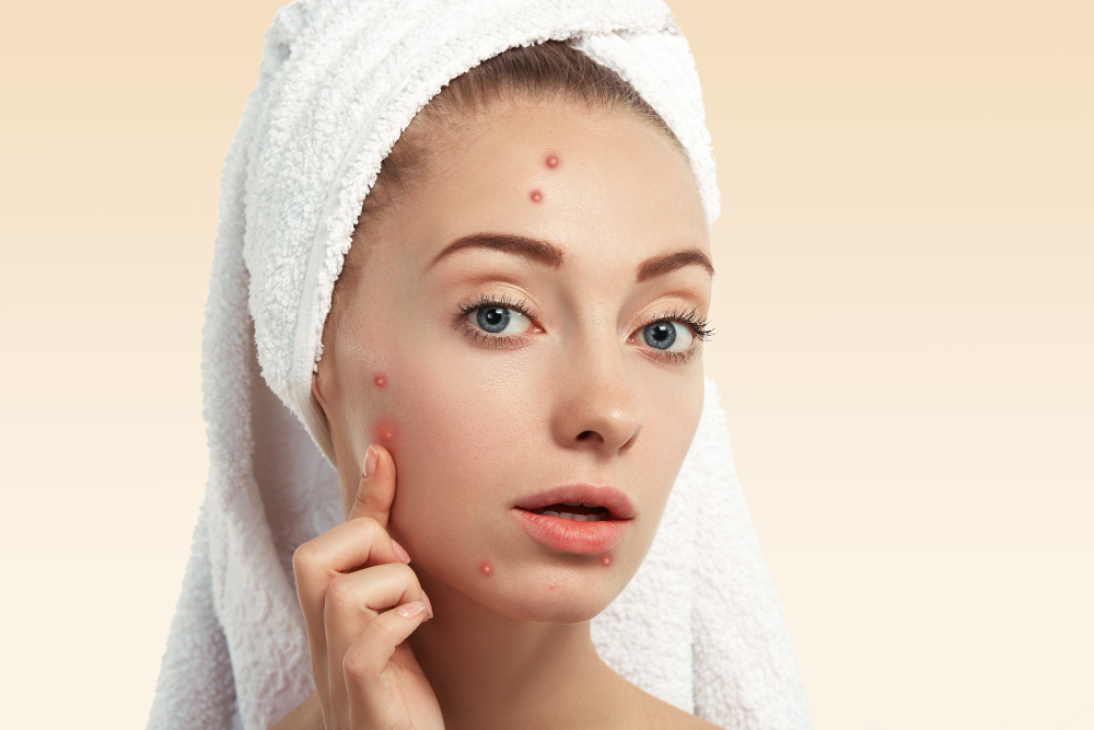 Acne & Scar Treatment